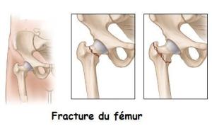 fracture-femur